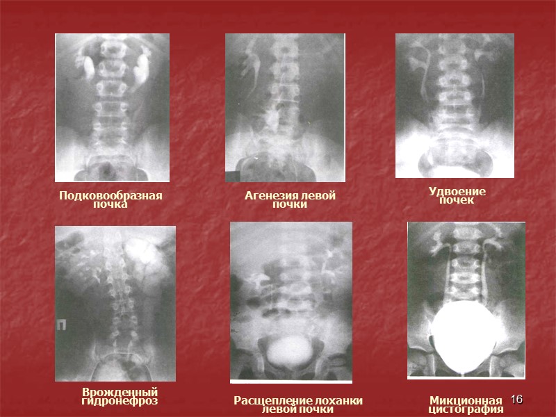 16 Микционная цистография.   Удвоение   почек Агенезия левой  почки Подковообразная